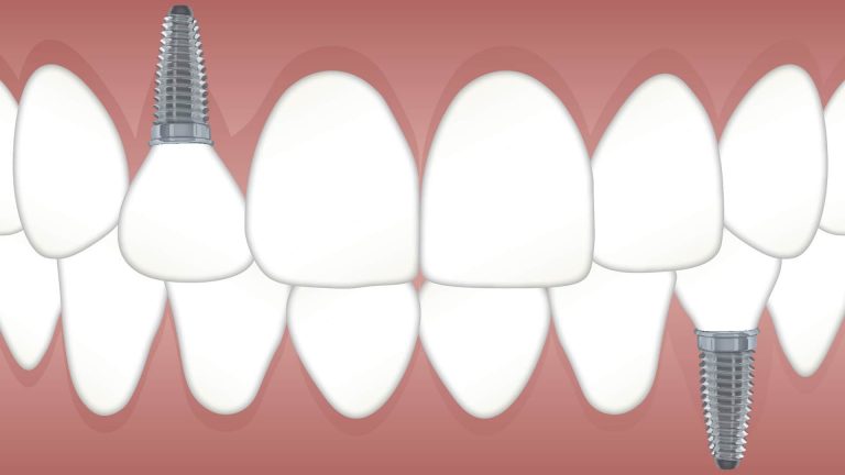 Read more about the article Myths About Dental Implants