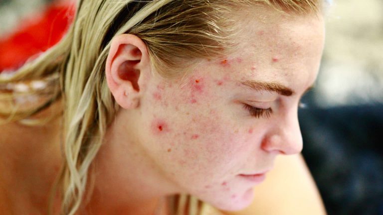 Read more about the article Care for People Who are Prone to Acne [Tips]