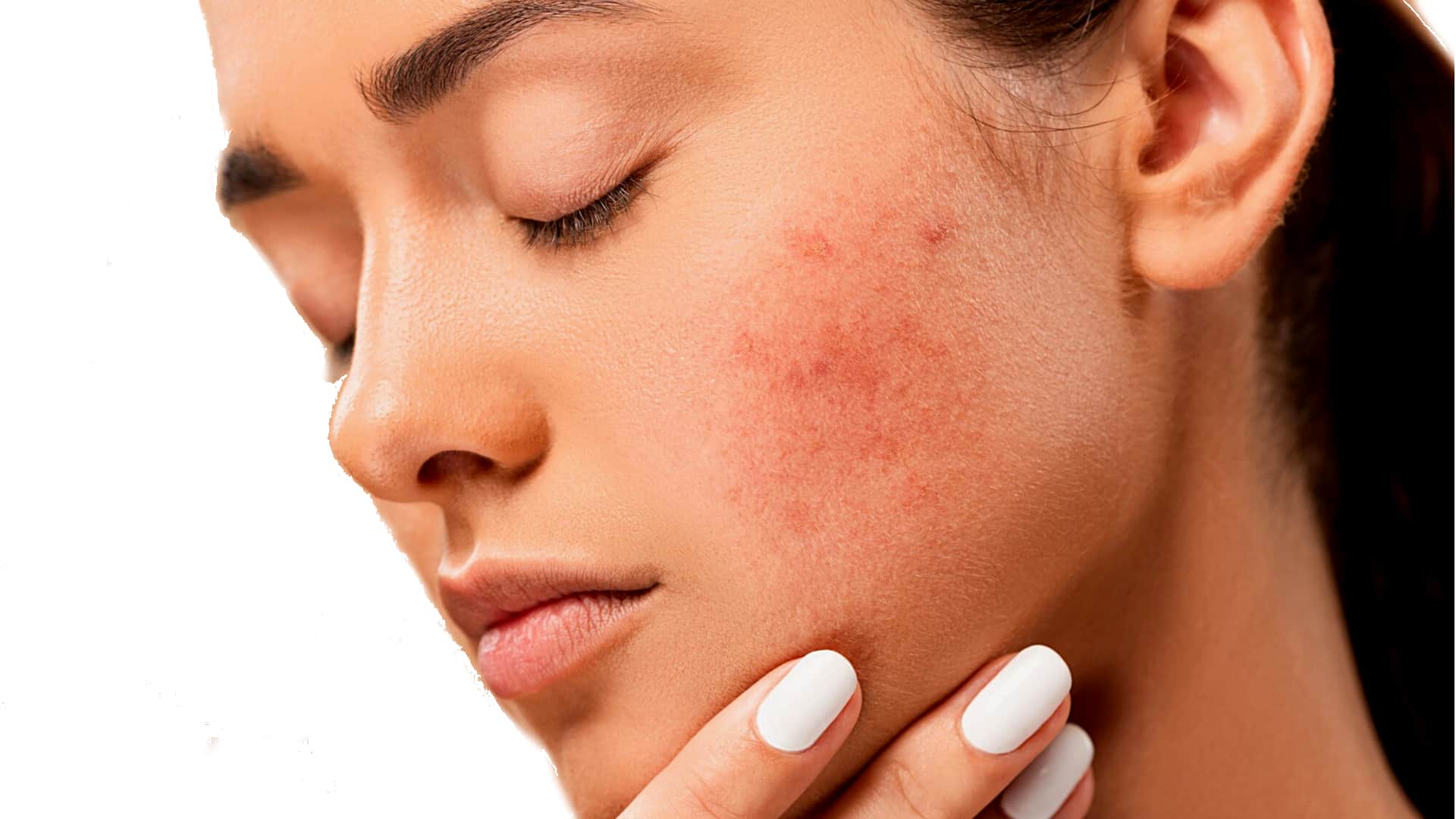 You are currently viewing Oily Skin Care – How to Prevent Youthful Pimples